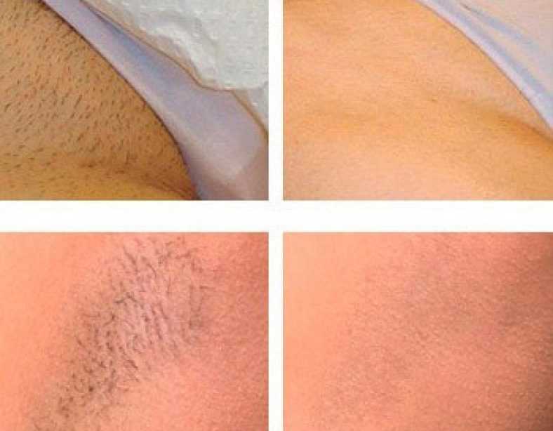 Что такое бразильская эпиляция: особенности удаления волос воском в зоне глубокого бикини