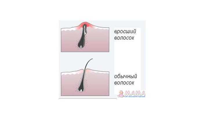 Способы удаления  волос на лице и теле