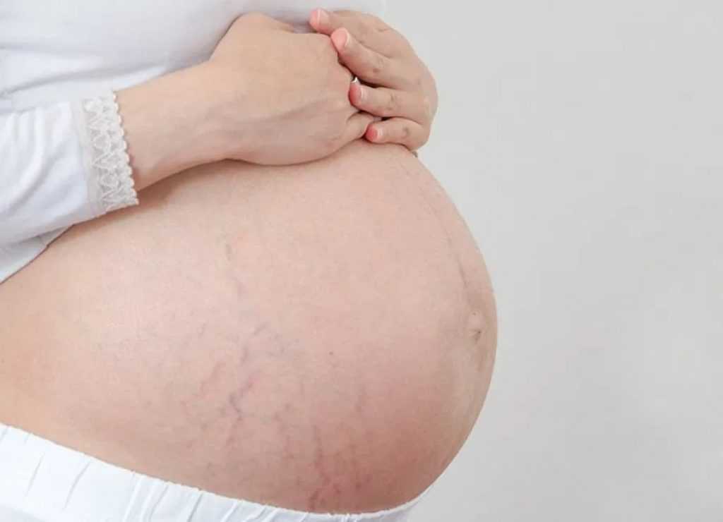 Как избежать растяжек при беременности: профилактика растяжек | mustela