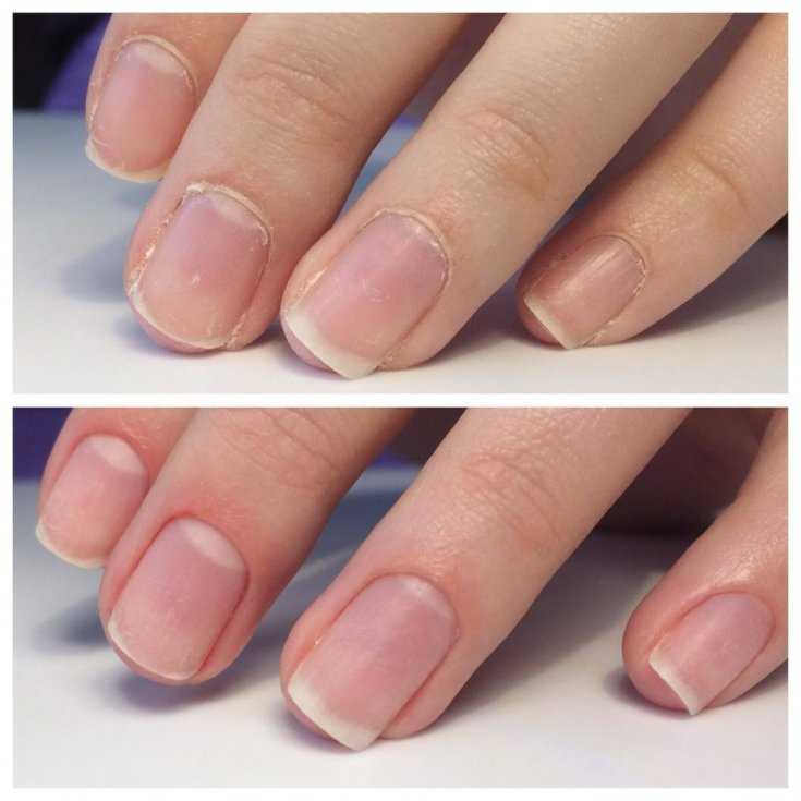 Как восстановить ногти после шеллака и гель-лака?
