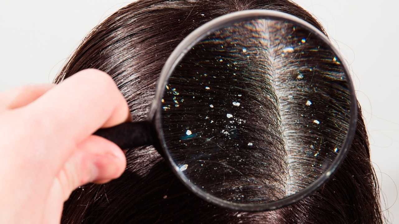 Можно ли мыть голову дегтярным мылом от перхоти, полезно ли, отзывы о том помогает ли средство против себореи, правильный способ применения для волос