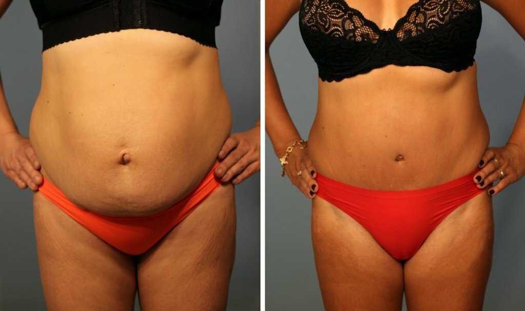 Как избавиться от лишней кожи на животе после похудения и родов?