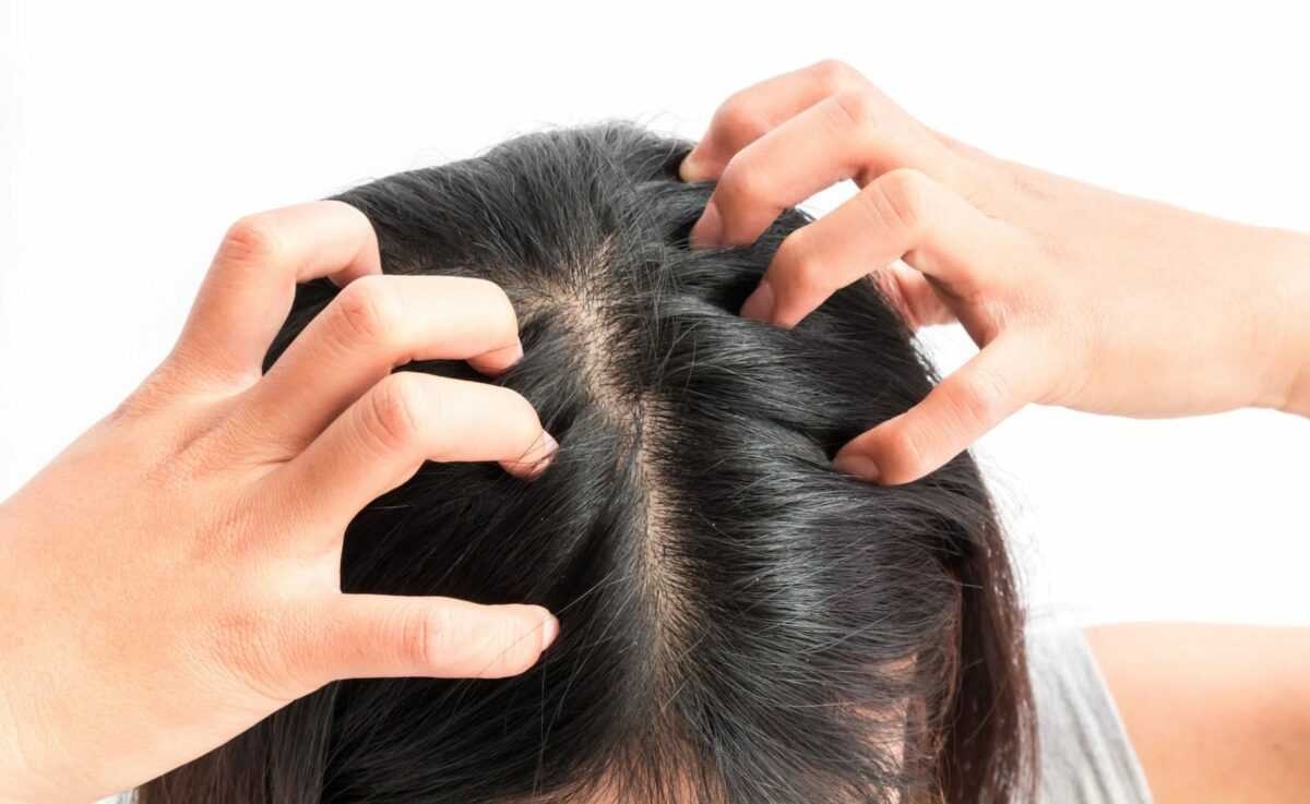 Себорейное выпадение волос: причины, лечение, профилактика