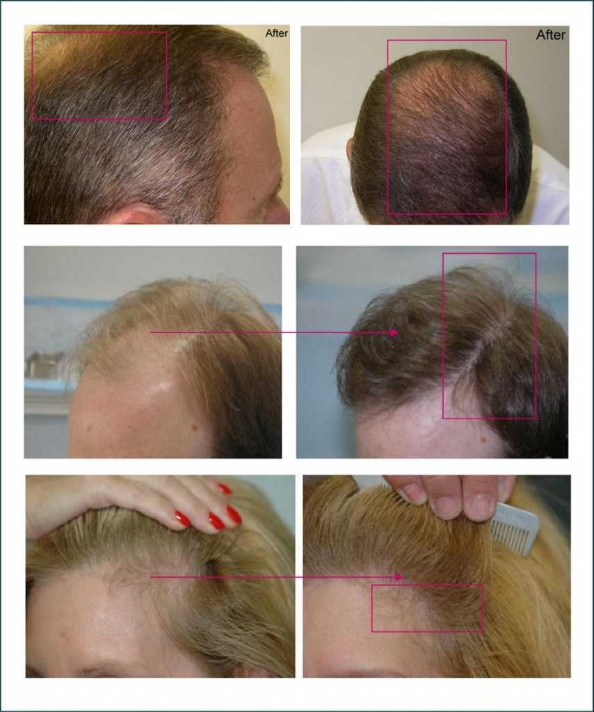 Результаты роста волос. Дарсонваль алопеция андрогенная. Плазмолифтинг алопеция. Плазмолифтинг для волос при алопеции.