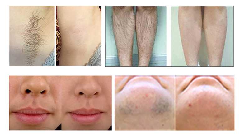 Как обезболить кожу перед эпиляцией чувствительных зон в домашних условиях?