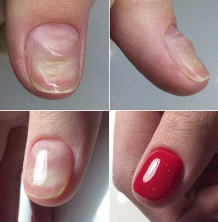 Как восстановить ногти после шеллака: самые эффективные пути решения проблемы
